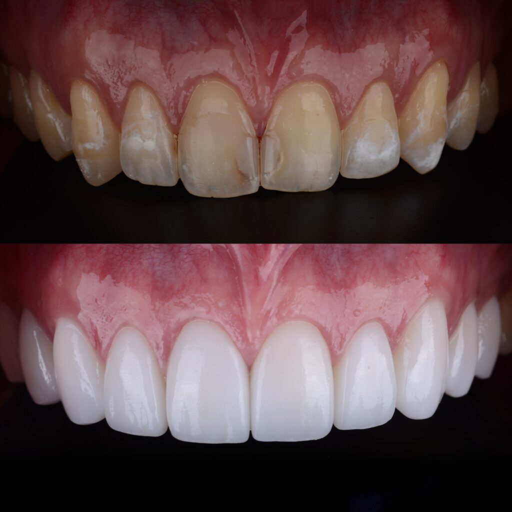 dental veneers greenwood